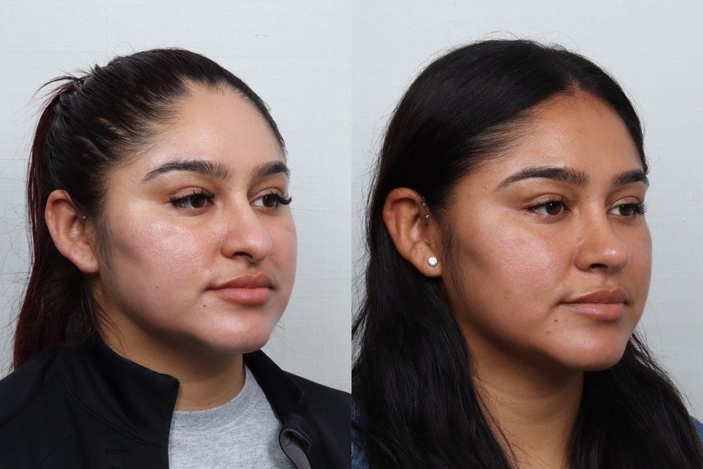 Rhinoplasty Before & After