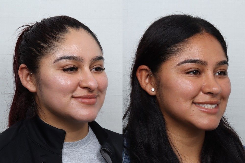 Rhinoplasty Before & After