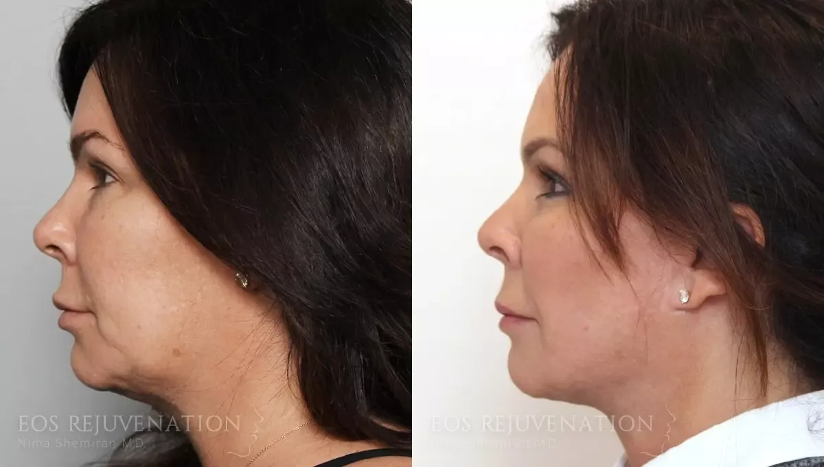 Facelift Before & After