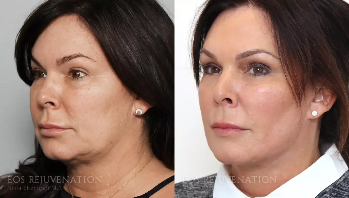 Facelift Before & After