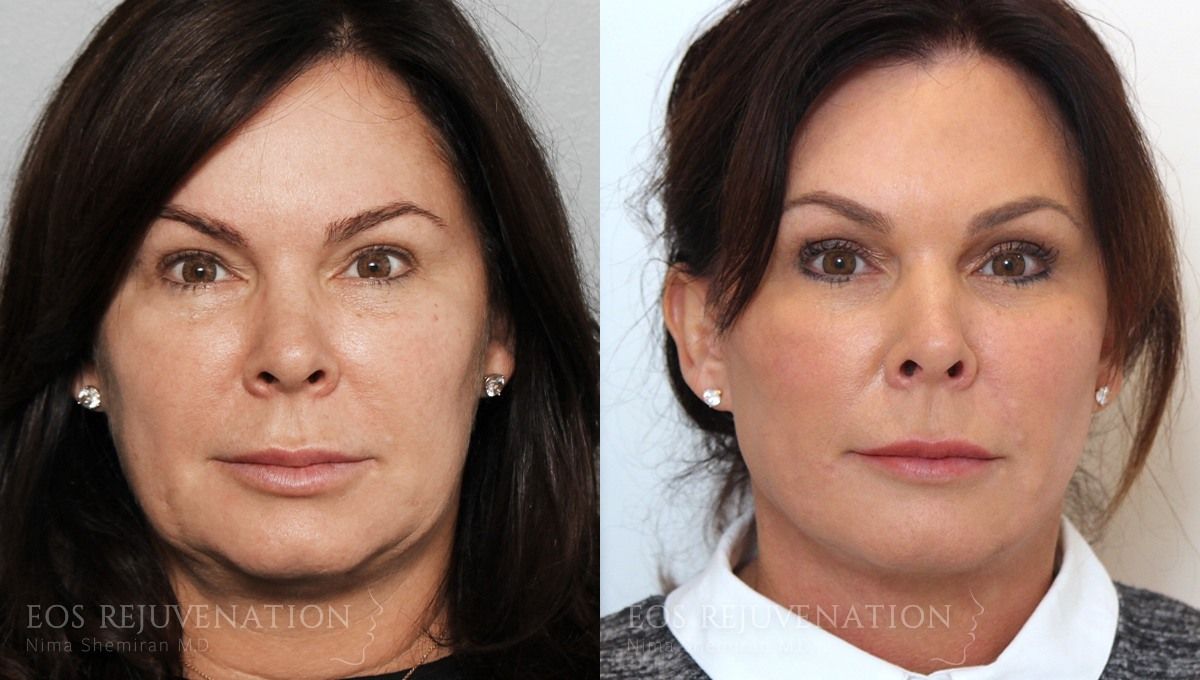 Facelift Before & After