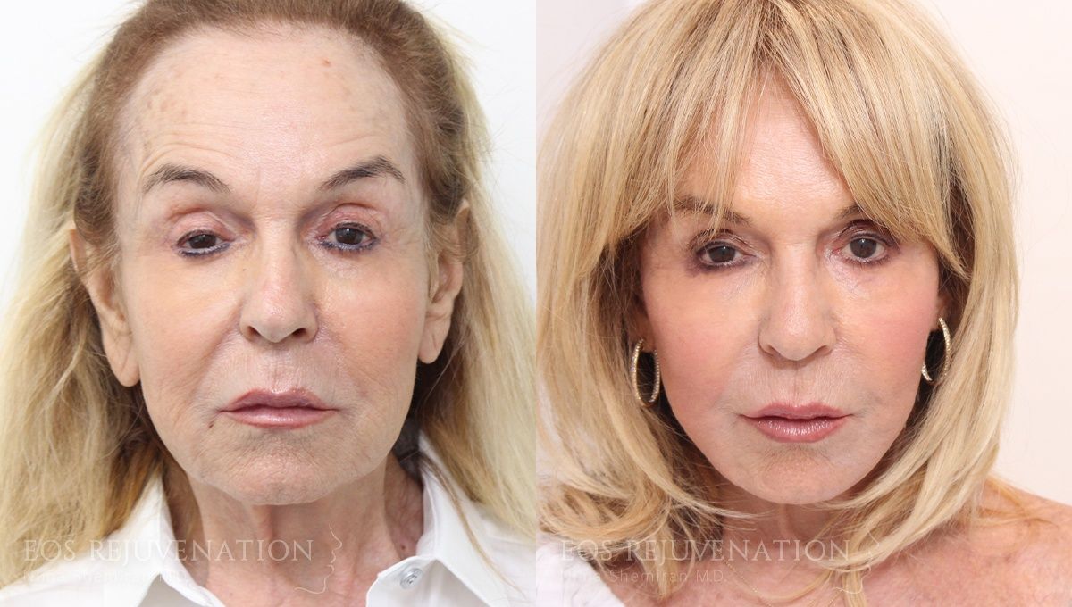 Facelift Before & After