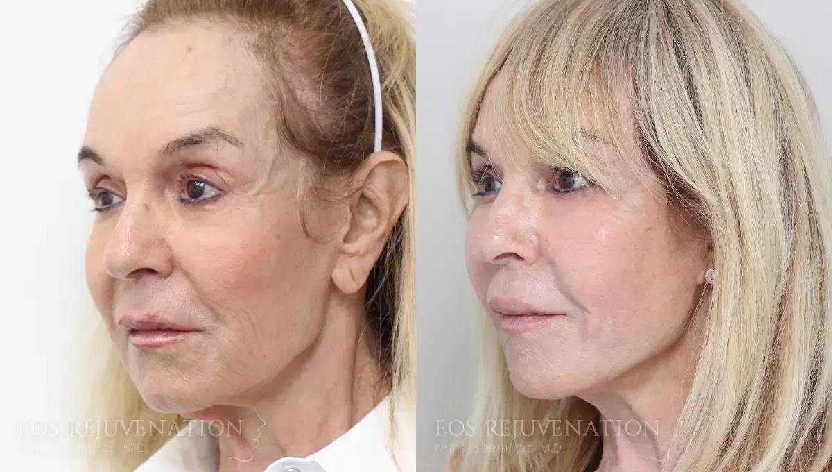 Facelift Before & After
