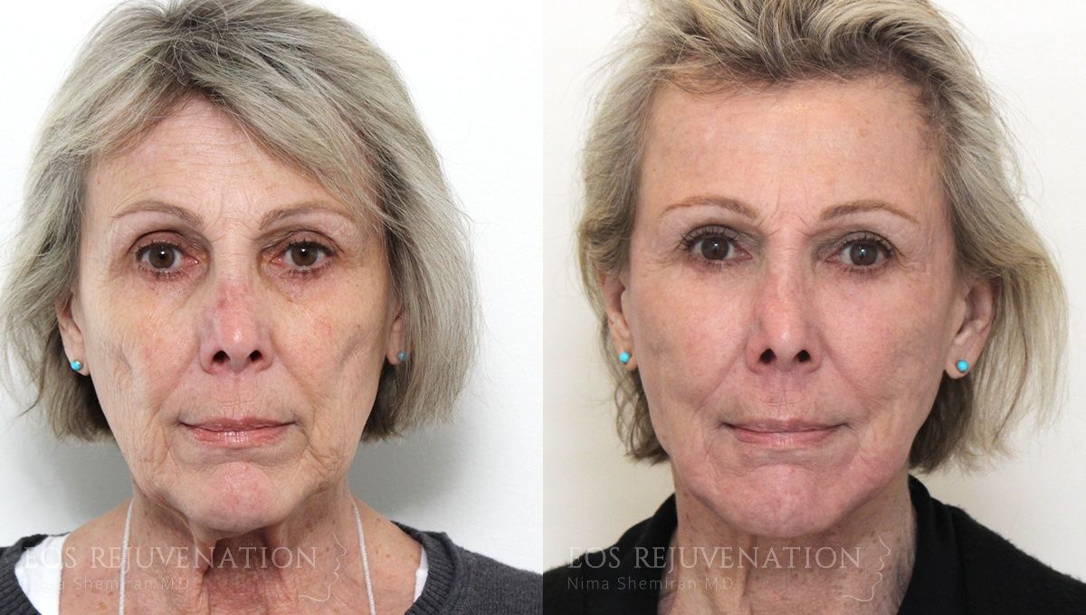 Facelift Before & After