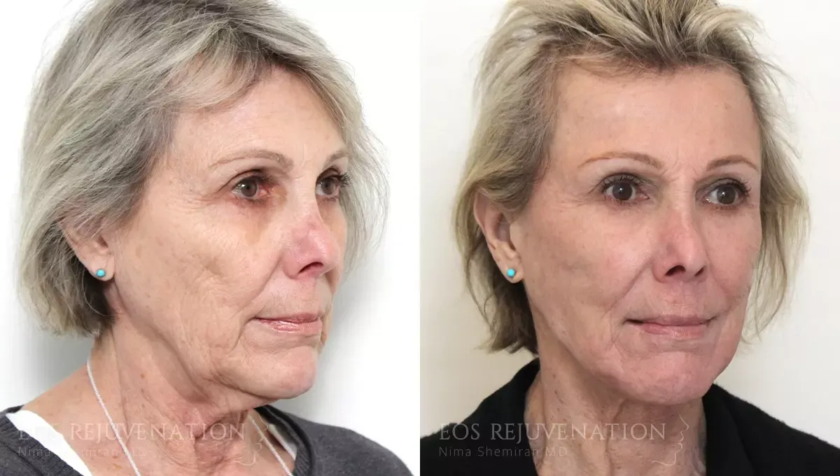 Facelift Before & After