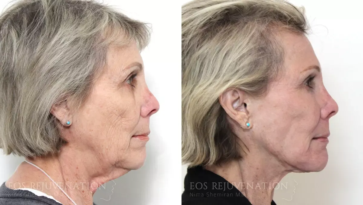 Facelift Before & After