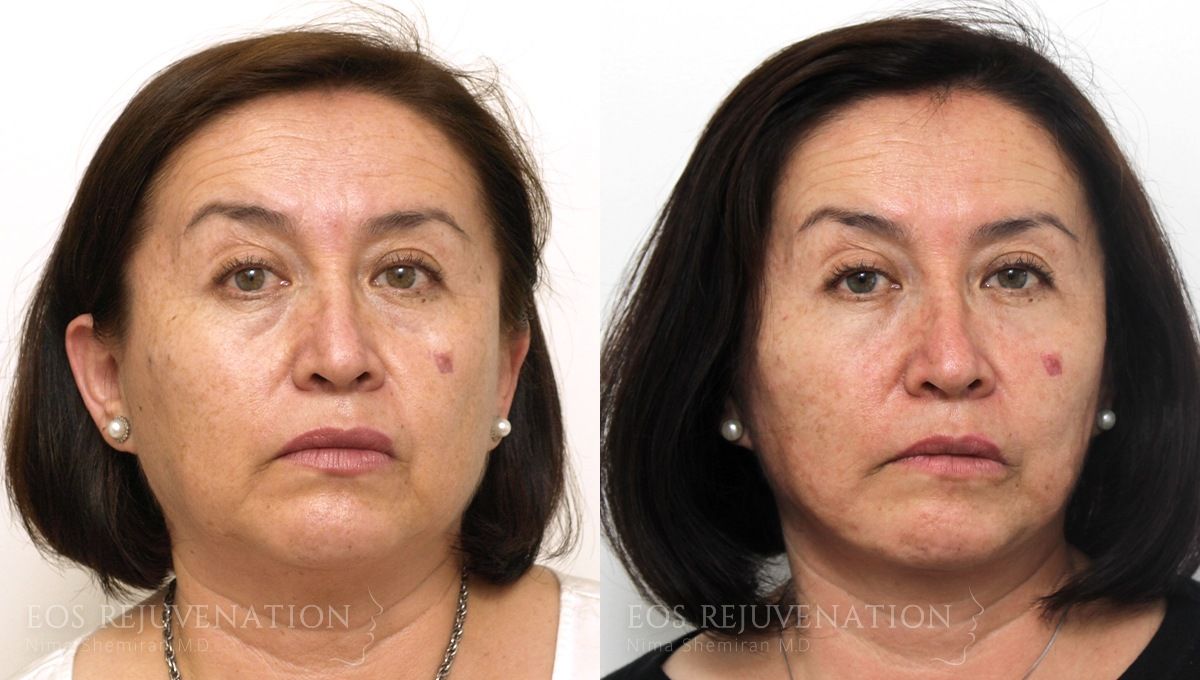 Facelift Before & After