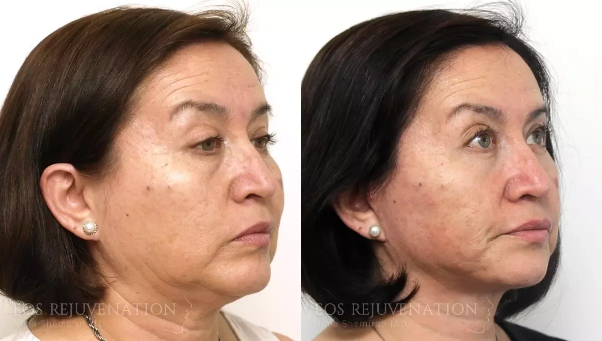 Facelift Before & After