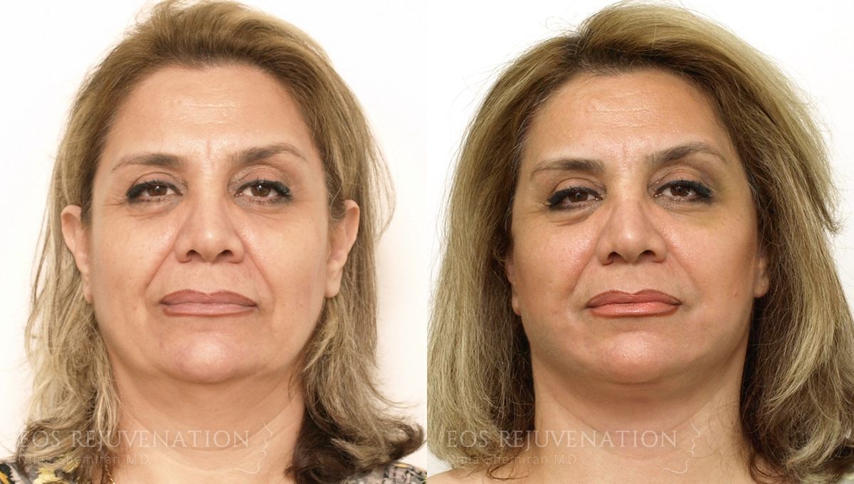 Facelift Before & After