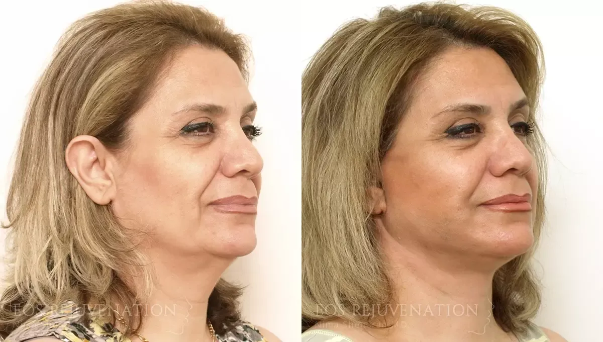 Facelift Before & After