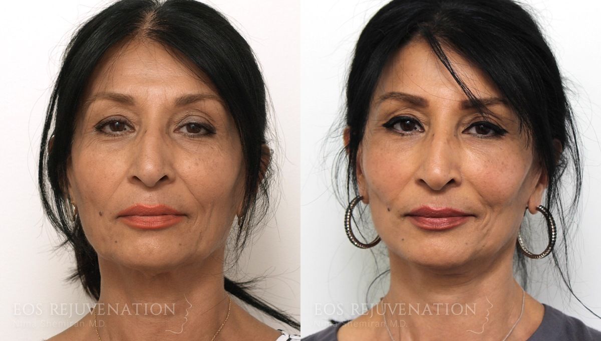Facelift Before & After