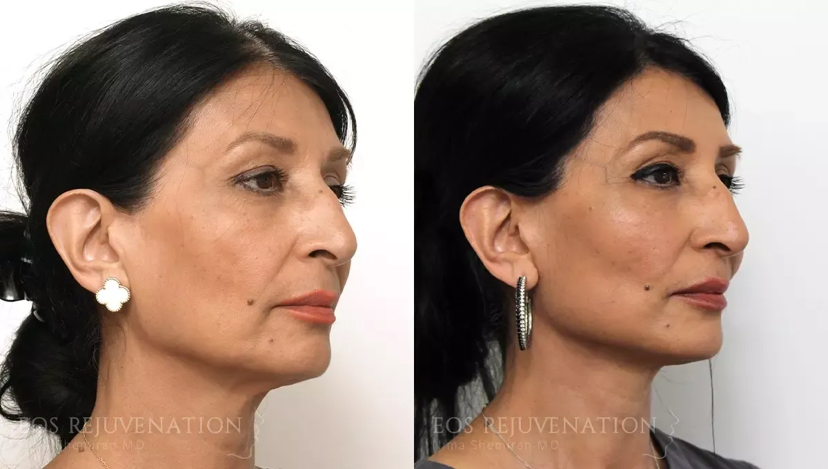 Facelift Before & After