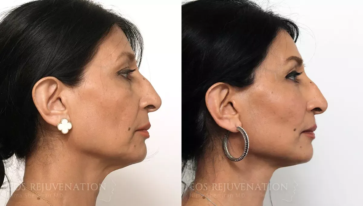 Facelift Before & After