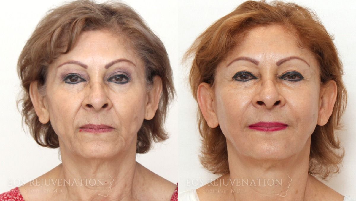 Facelift Before & After