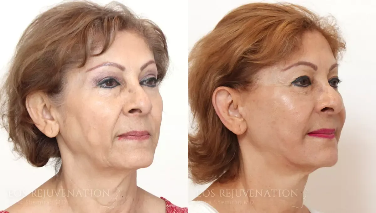 Facelift Before & After
