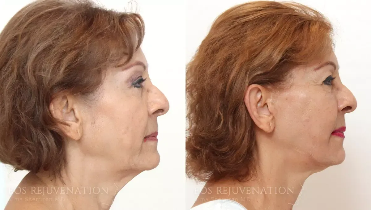 Facelift Before & After