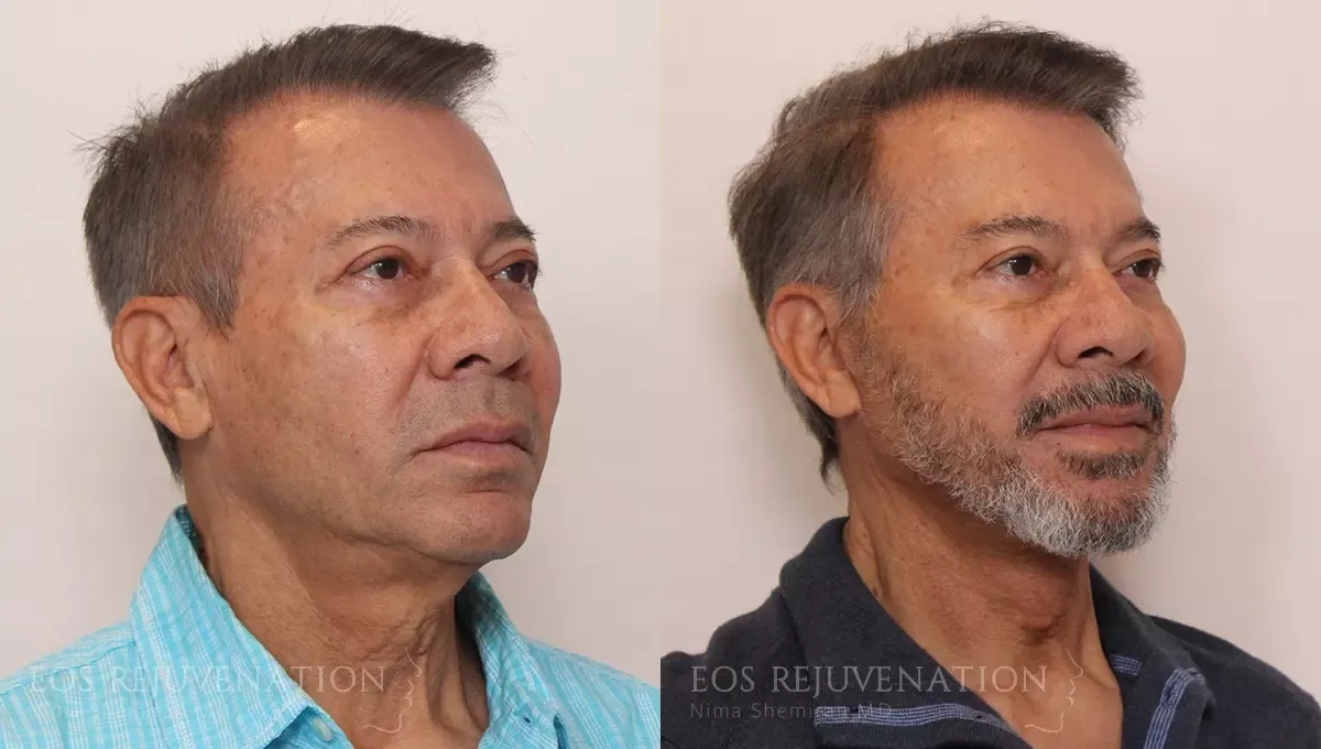 Facelift Before & After