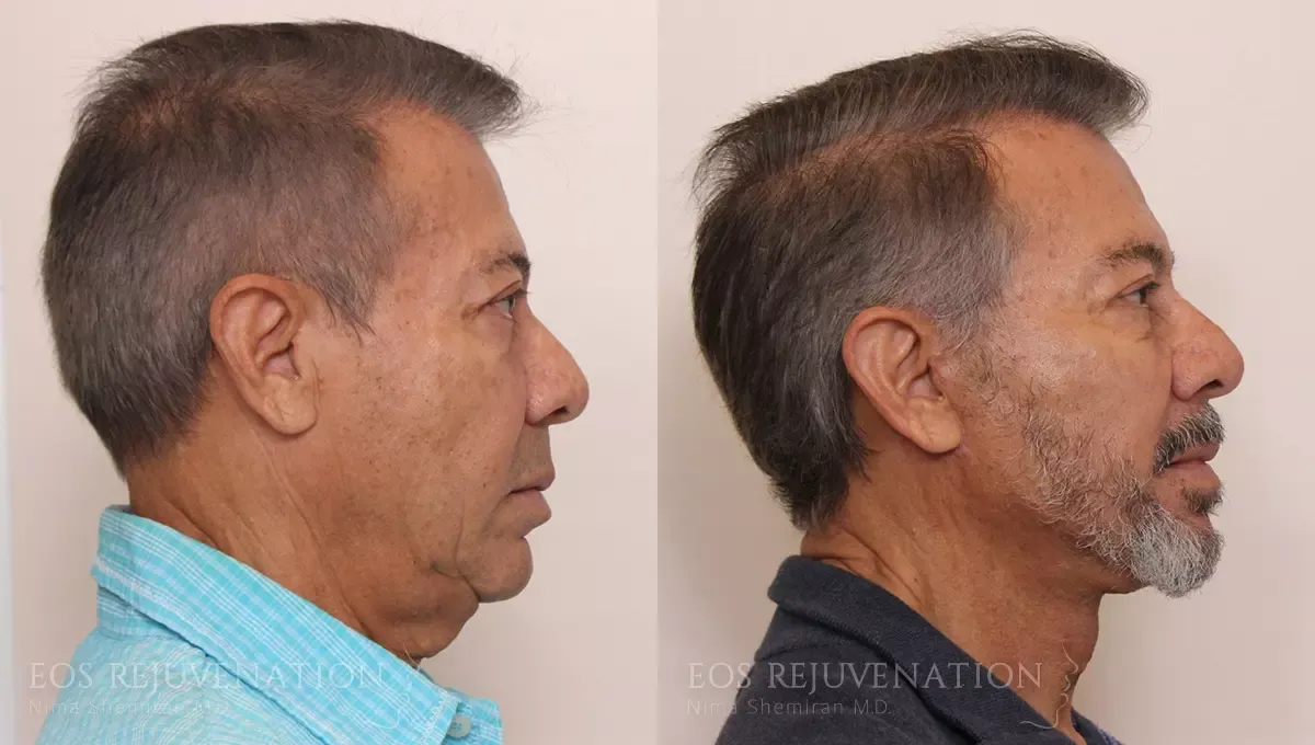 Facelift Before & After