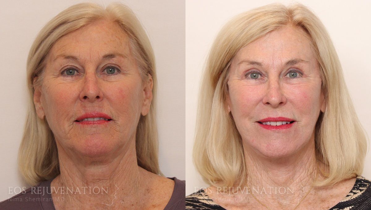 Facelift Before & After