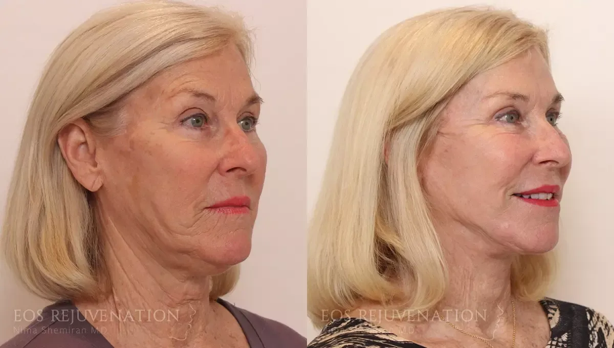 Facelift Before & After