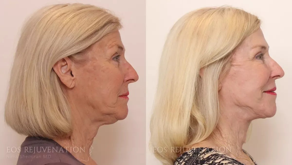 Facelift Before & After