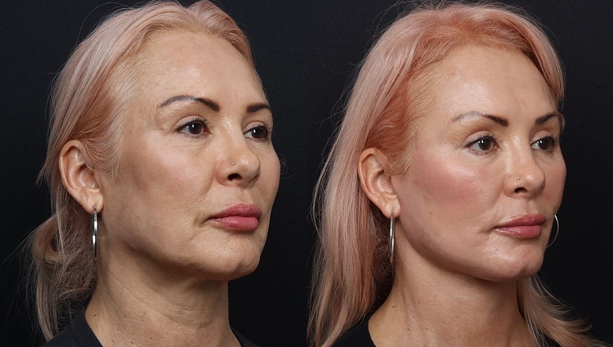 Before and after cosmetic enhancement side profile.