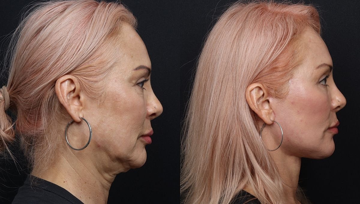 Compare before and after facial transformation results.
