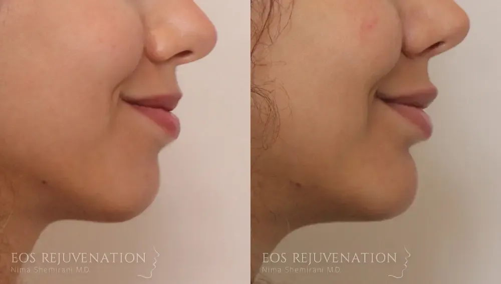 Chin Augmentation Before & After