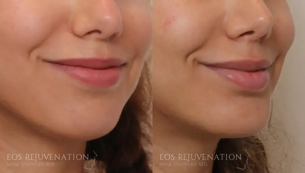Chin Augmentation Before & After