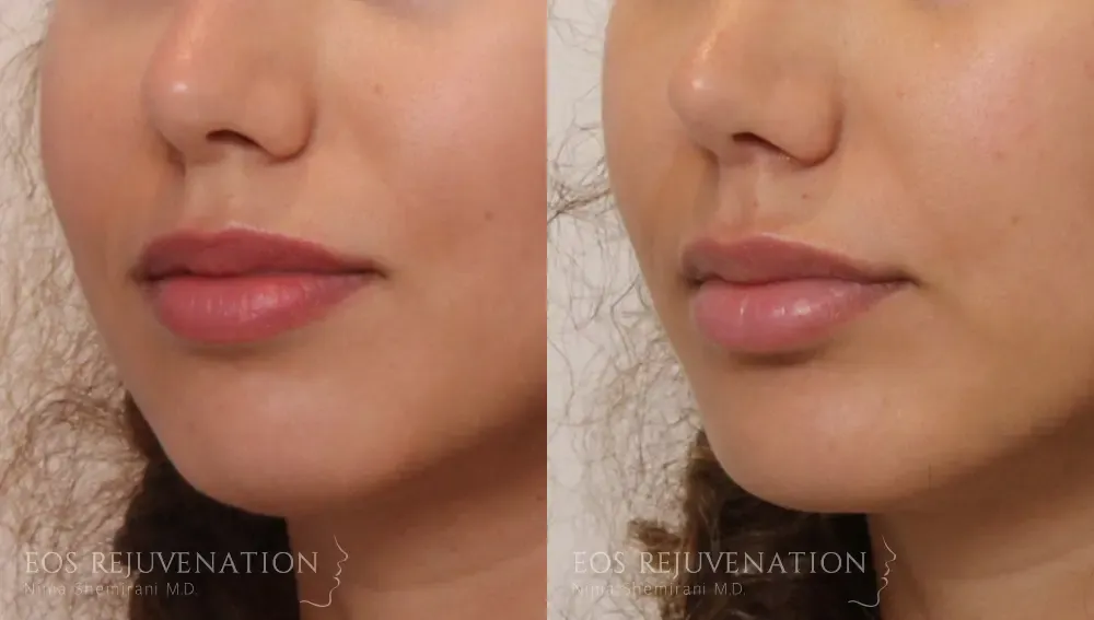 Chin Augmentation Before & After