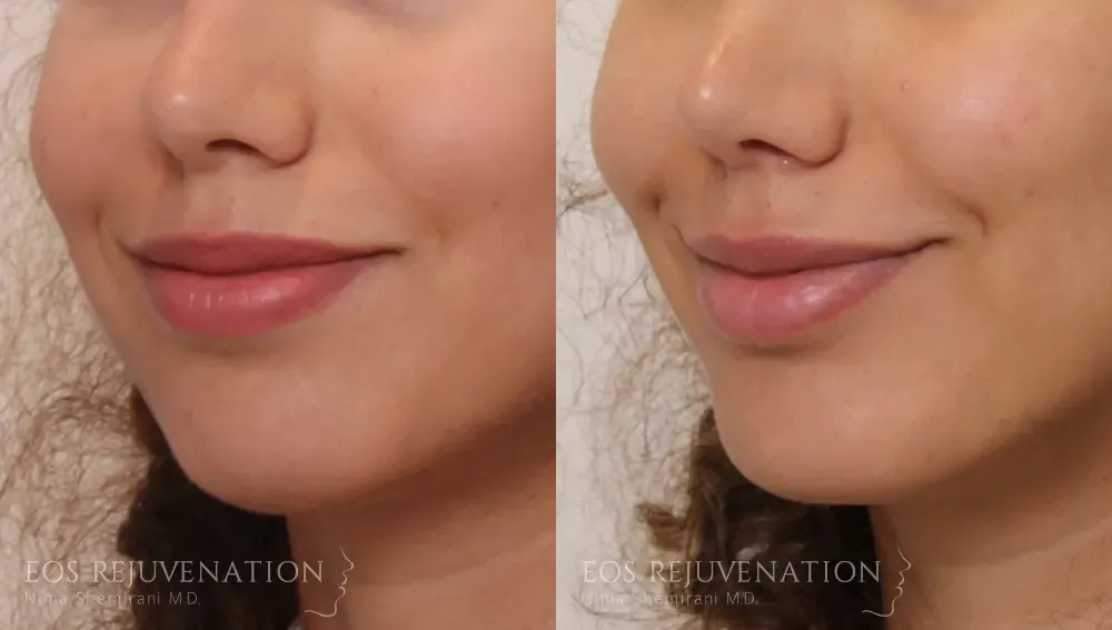 Chin Augmentation Before & After