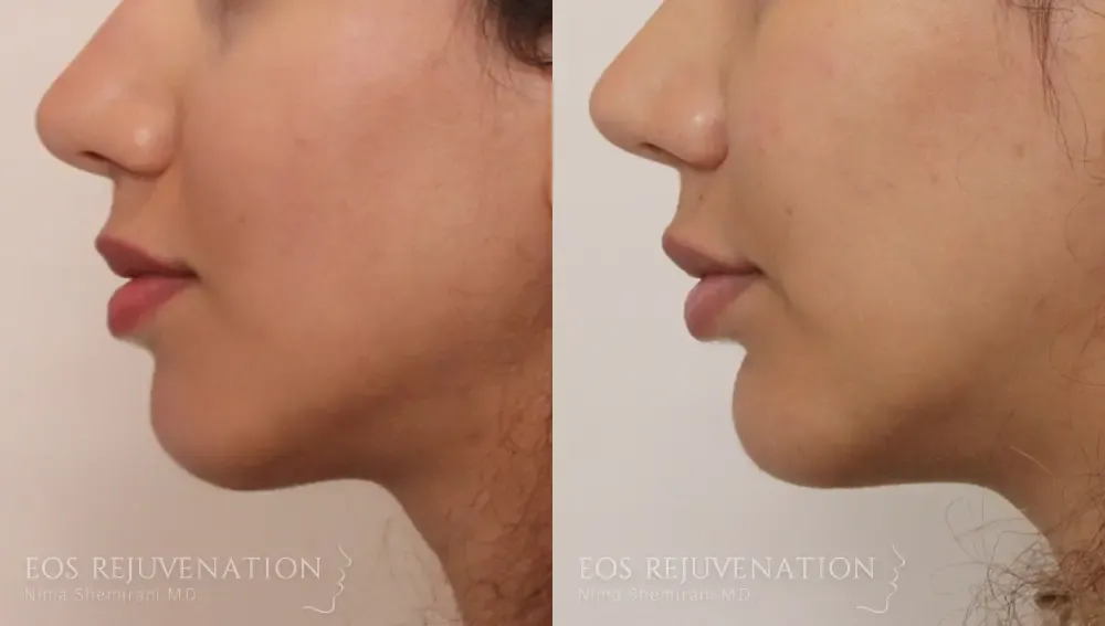 Chin Augmentation Before & After