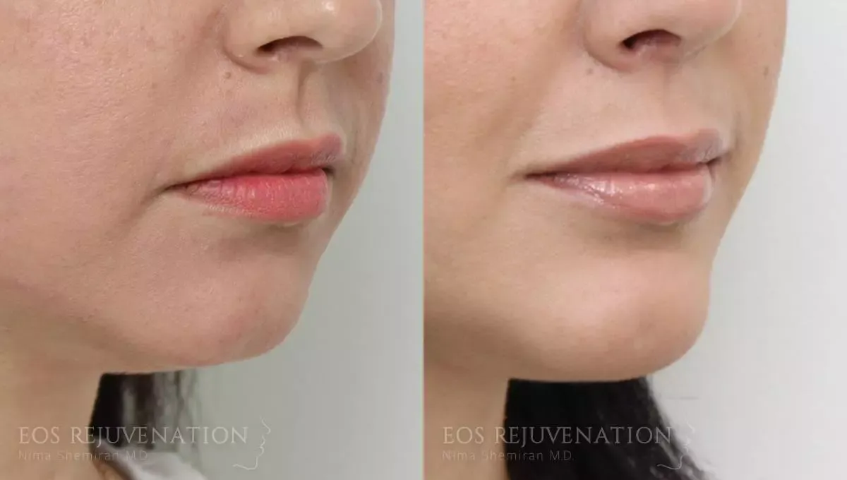 Chin Augmentation Before & After