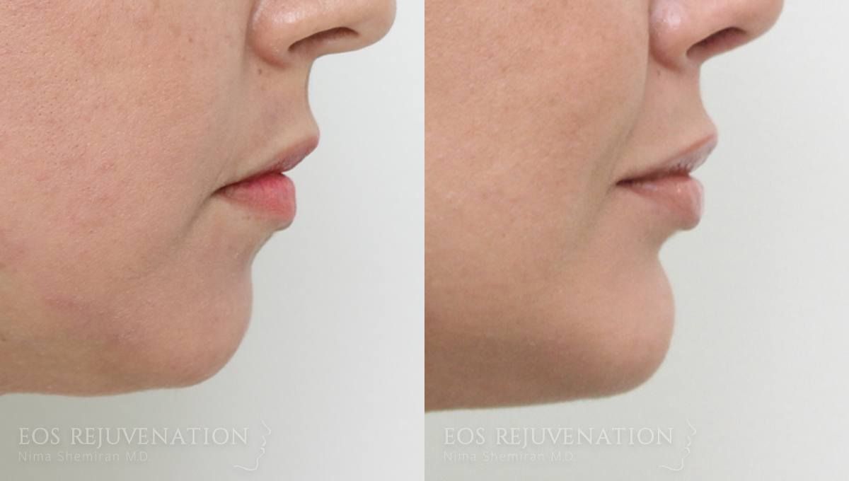 Chin Augmentation Before & After
