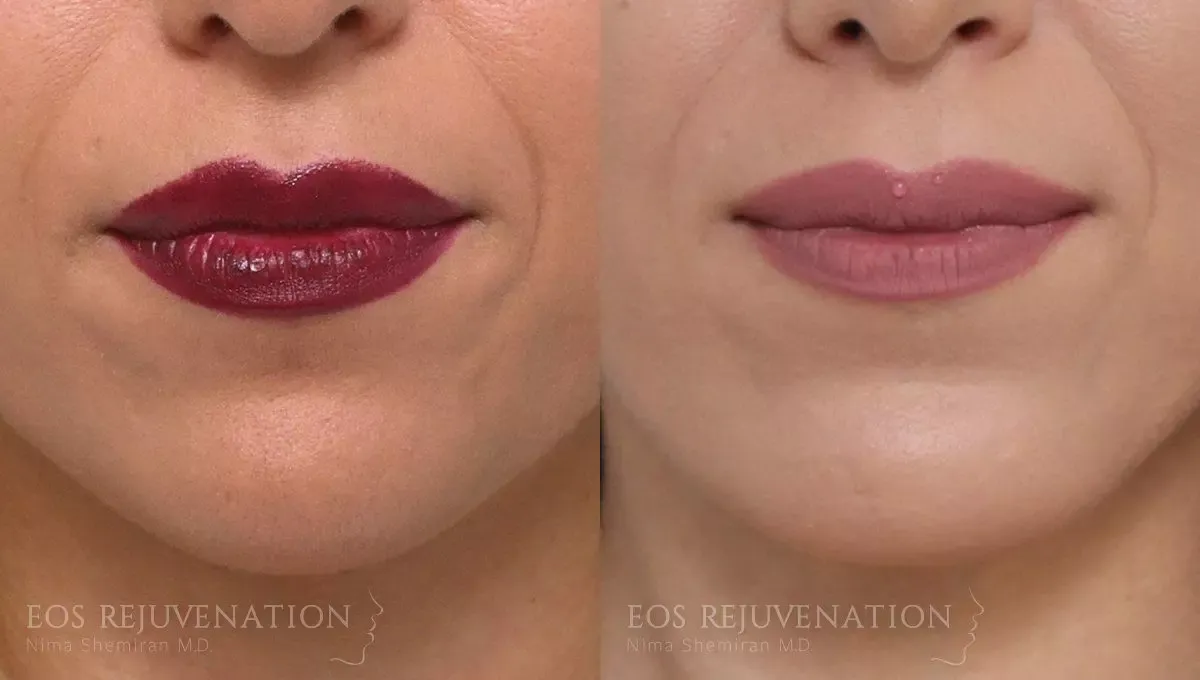 Chin Augmentation Before & After