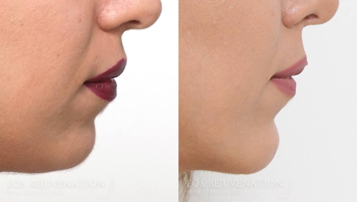 Chin Augmentation Before & After