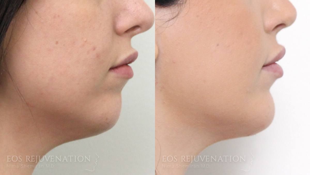 Chin Augmentation Before & After