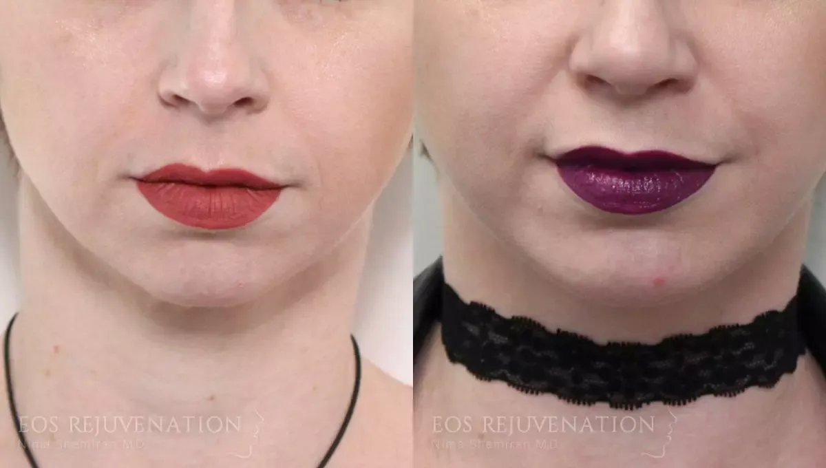 Chin Augmentation Before & After