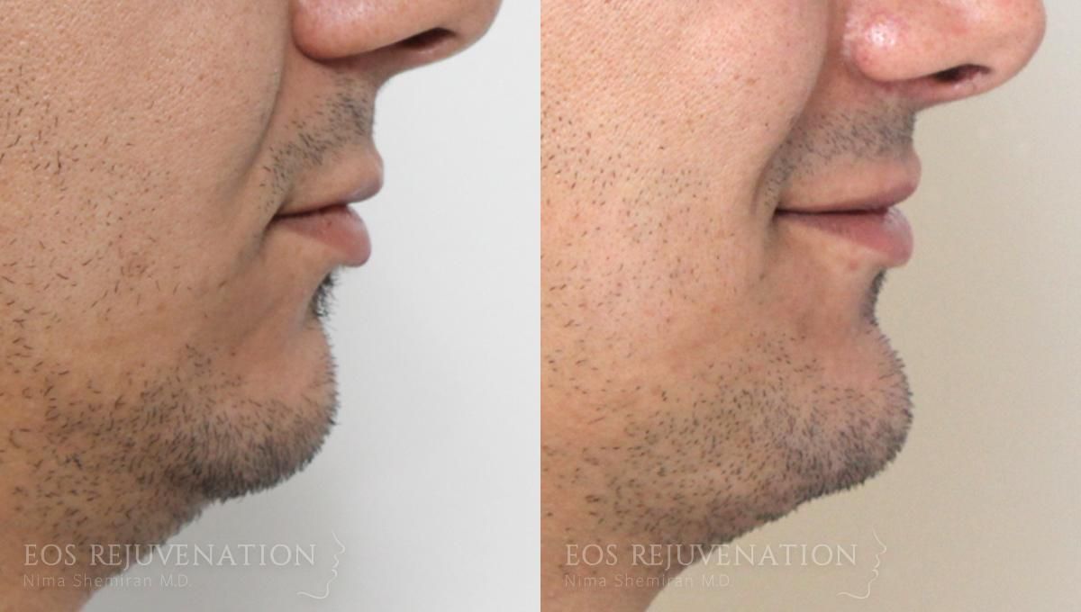 Chin Augmentation Before & After