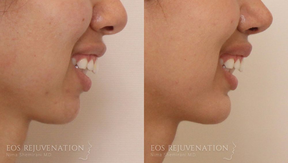 Chin Augmentation Before & After