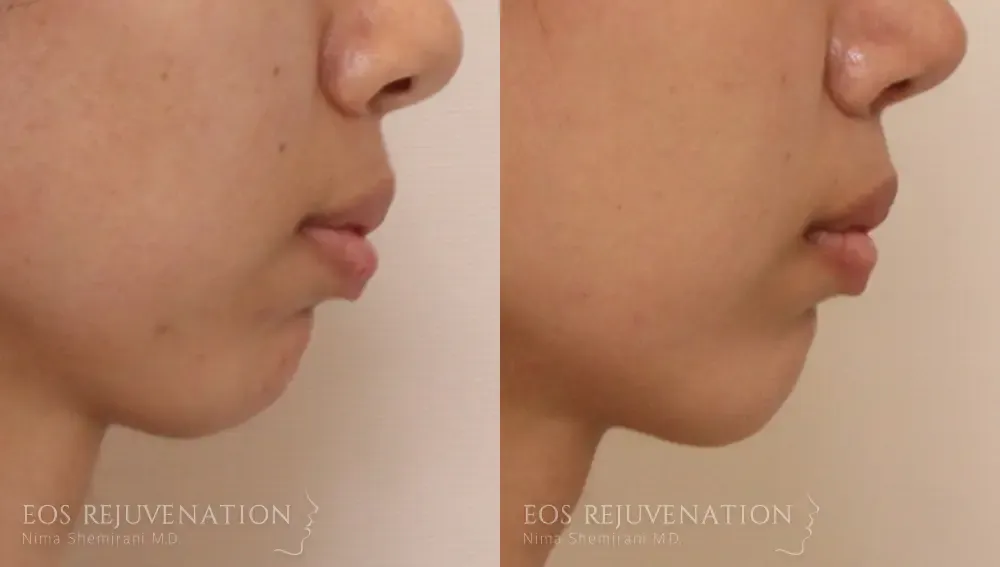 Chin Augmentation Before & After