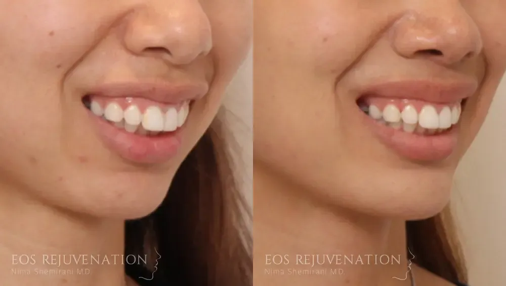 Chin Augmentation Before & After