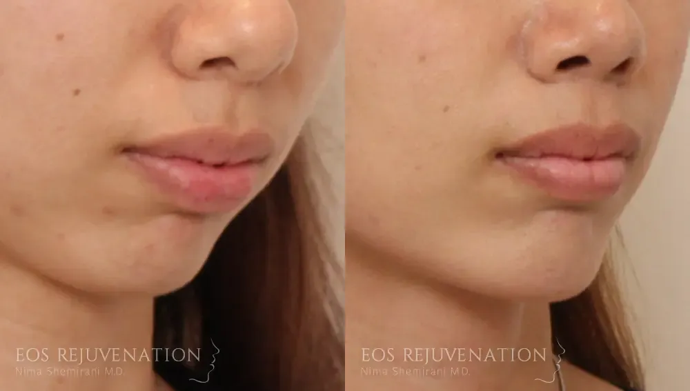 Chin Augmentation Before & After