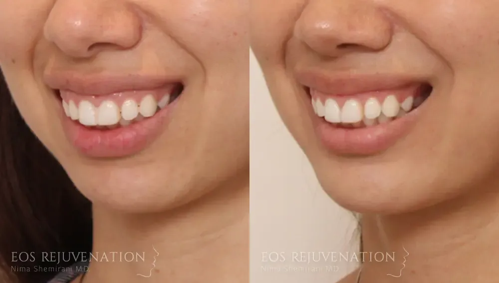 Chin Augmentation Before & After