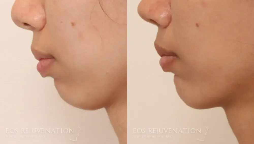 Chin Augmentation Before & After