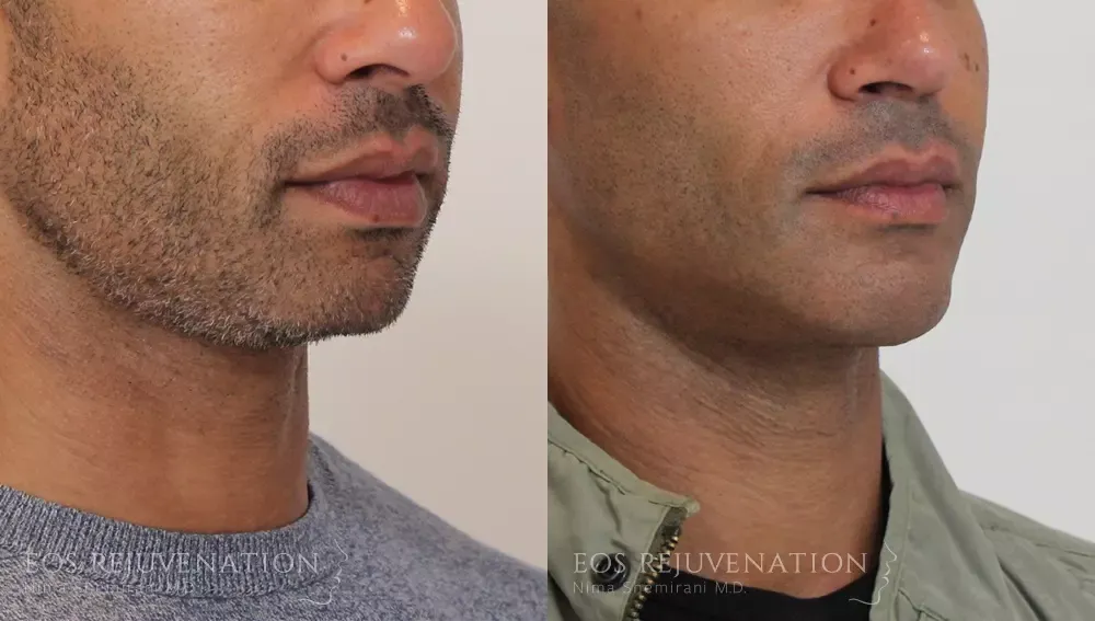 Chin Augmentation Before & After