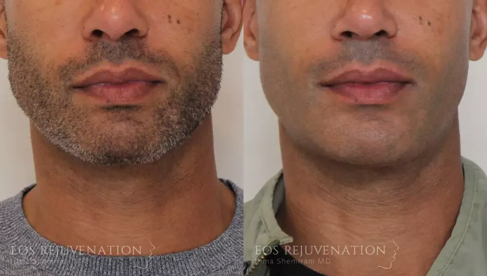Chin Augmentation Before & After