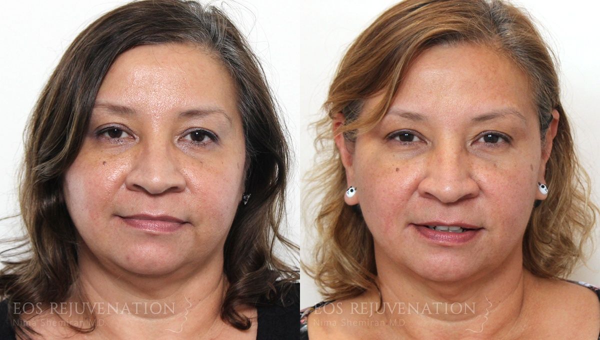 Botox Dysport Before & After