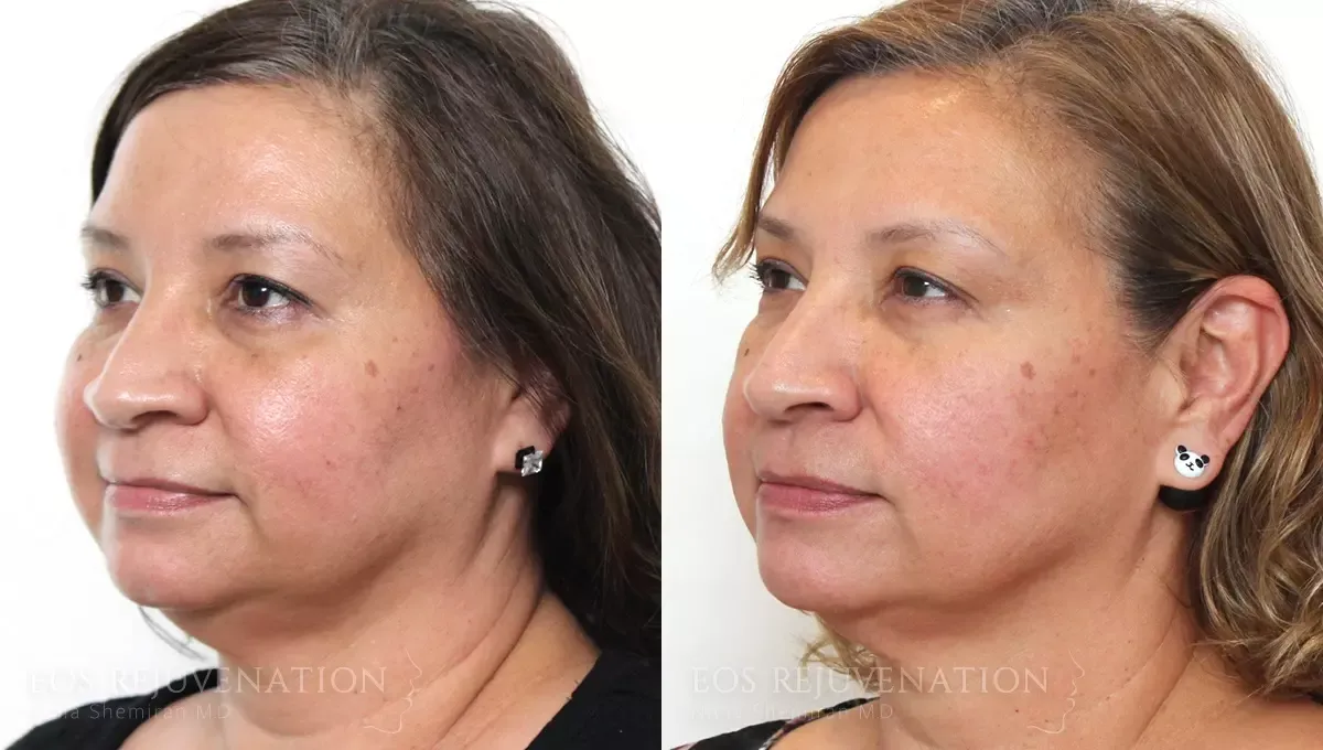 Botox Dysport Before & After