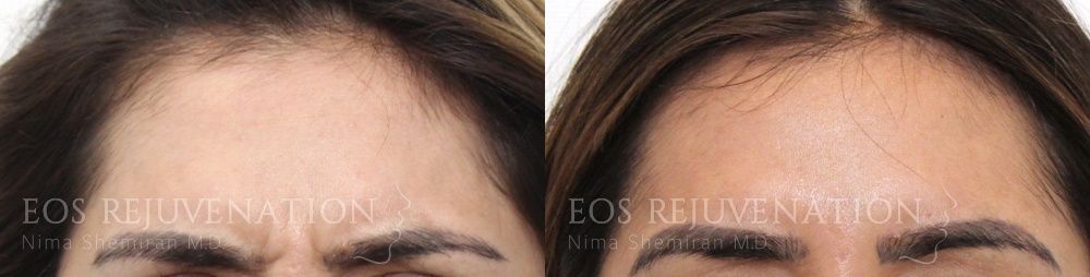 Botox Dysport Before & After